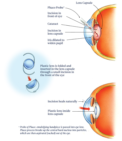 explaining multi-focal implant surgery