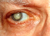 surgery to remove cataracts